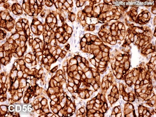 Carotid body tumour CD56_IZ.jpg